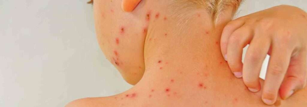 Buy calamine ointment for chickenpox.