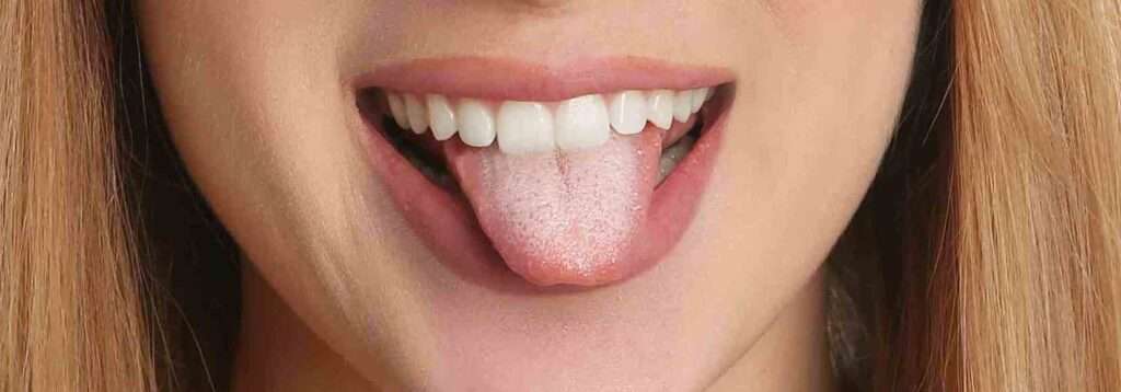 Does mouthwash for thrush work?